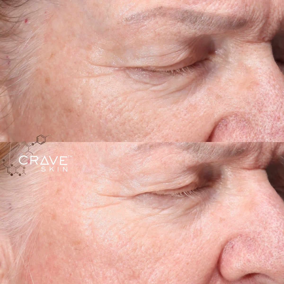 crave skin clinical results subject11 Seen improvement in wrinkles