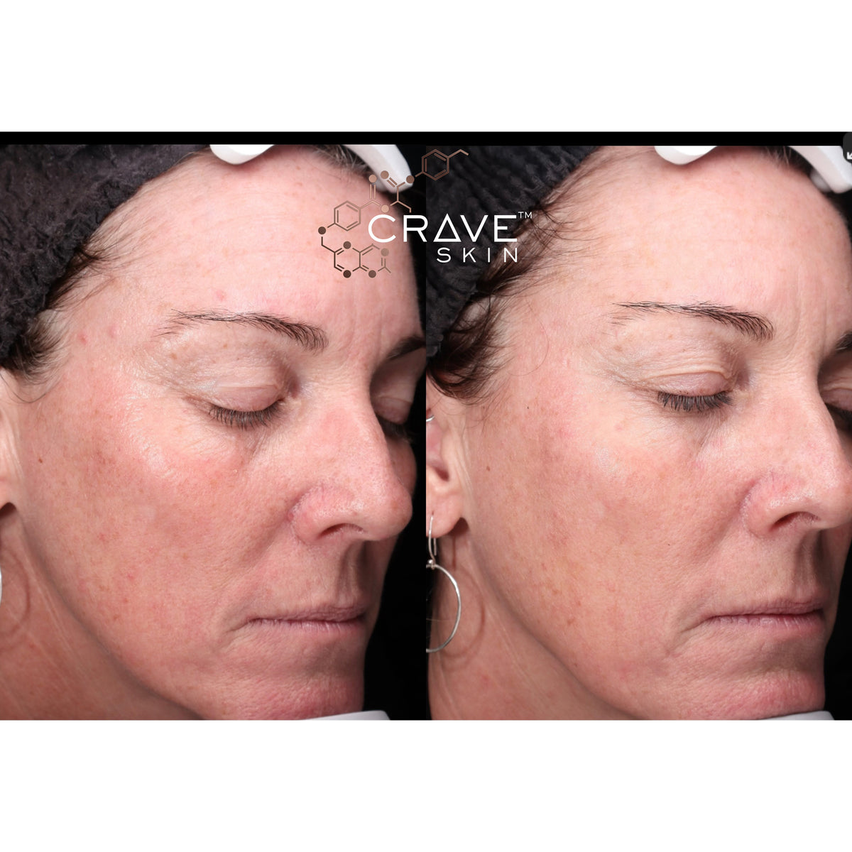 crave skin clinical results subject12 Seen improvement in redness