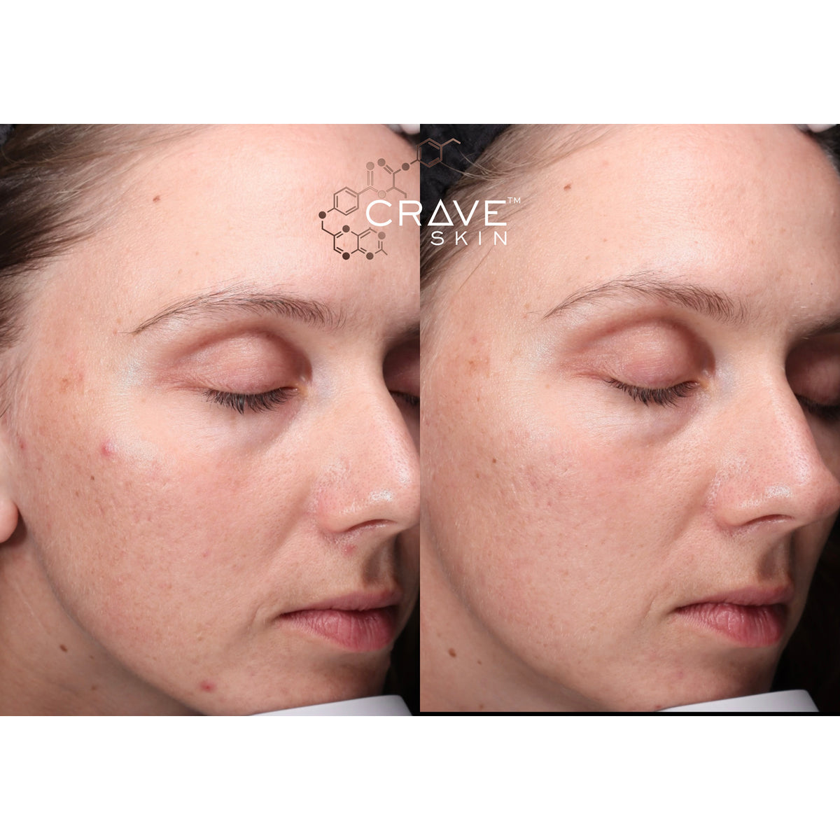 crave skin clinical results subject14 Seen improvement in pores