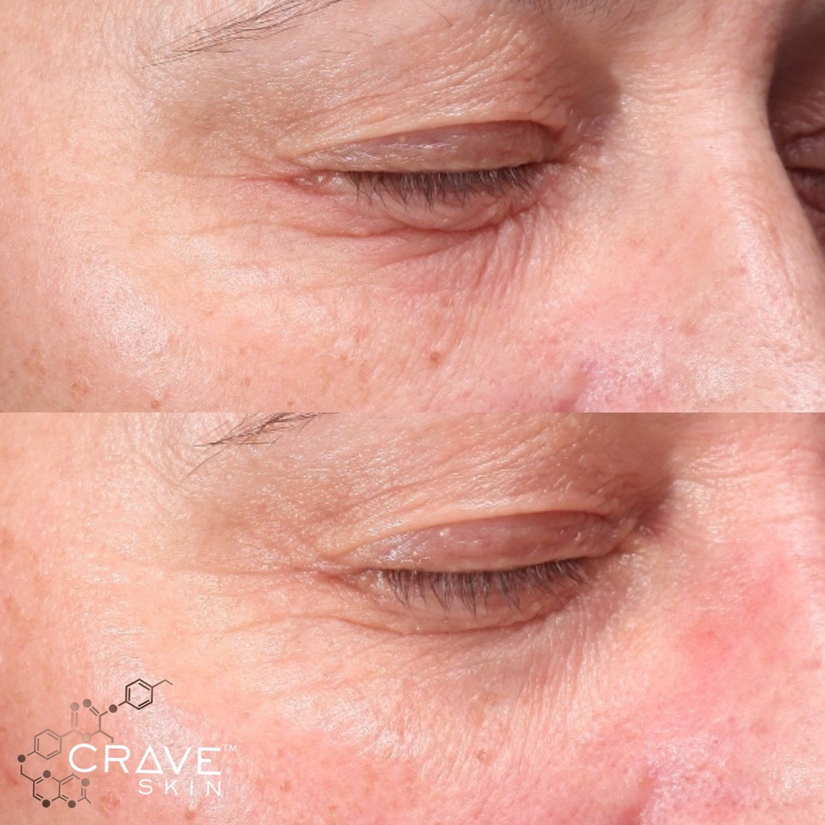 crave skin clinical results subject15 Seen improvement in texture