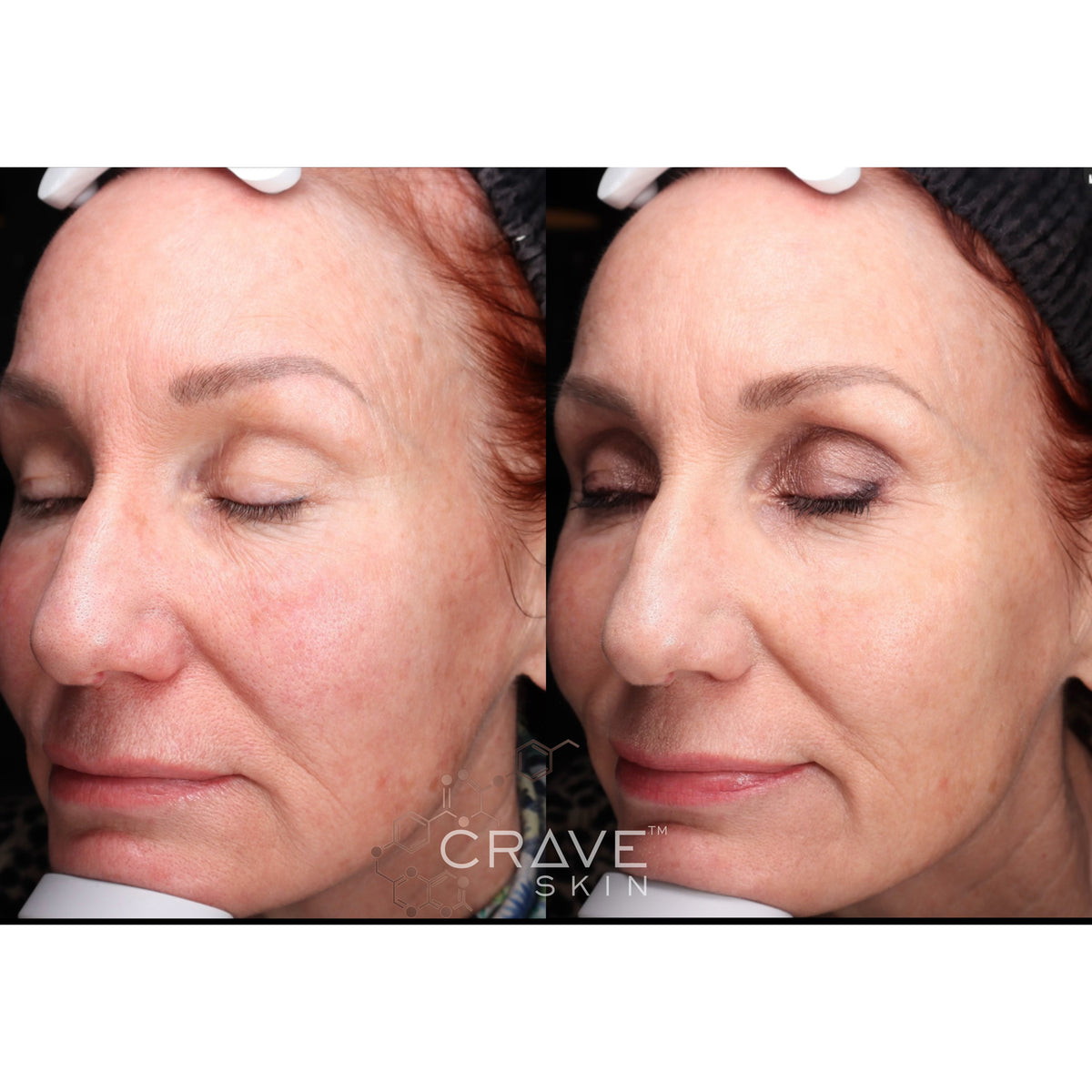 crave skin clinical results subject6 Seen improvement in wrinkles
