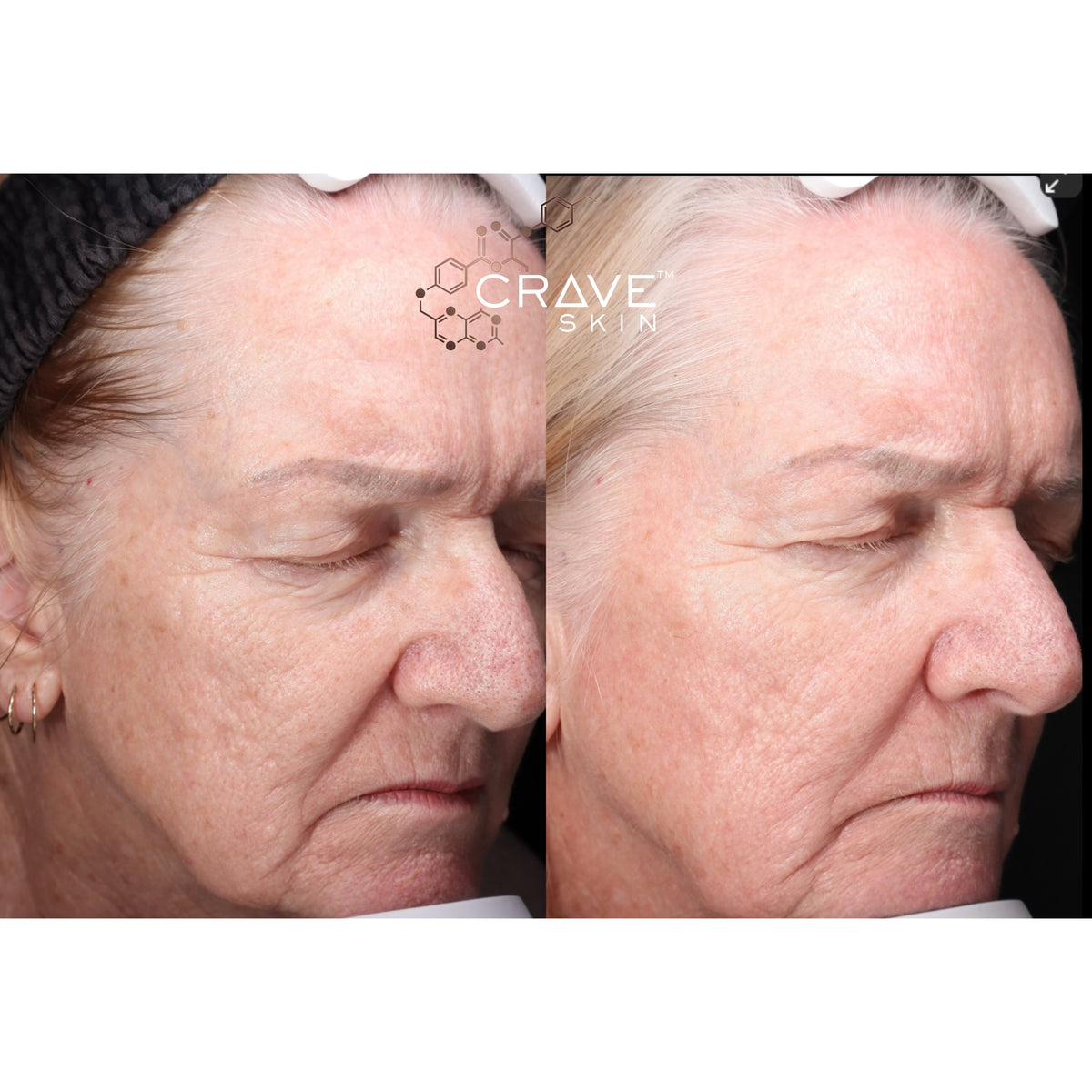 crave skin clinical results subject7 Seen improvement in texture