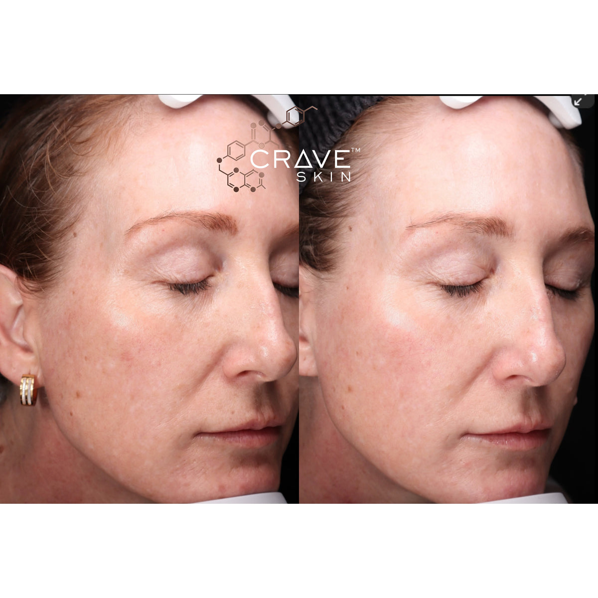 crave skin clinical results subject8 Seen improvement in Pores
